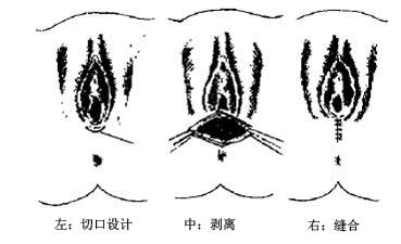 阴道紧缩术